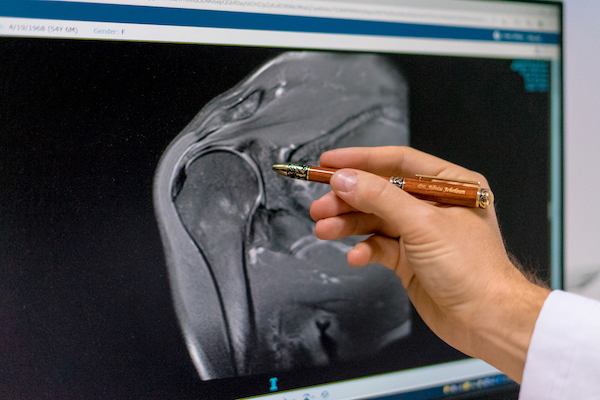 Radiografie reprezentand ruptura coafei rotatorilor